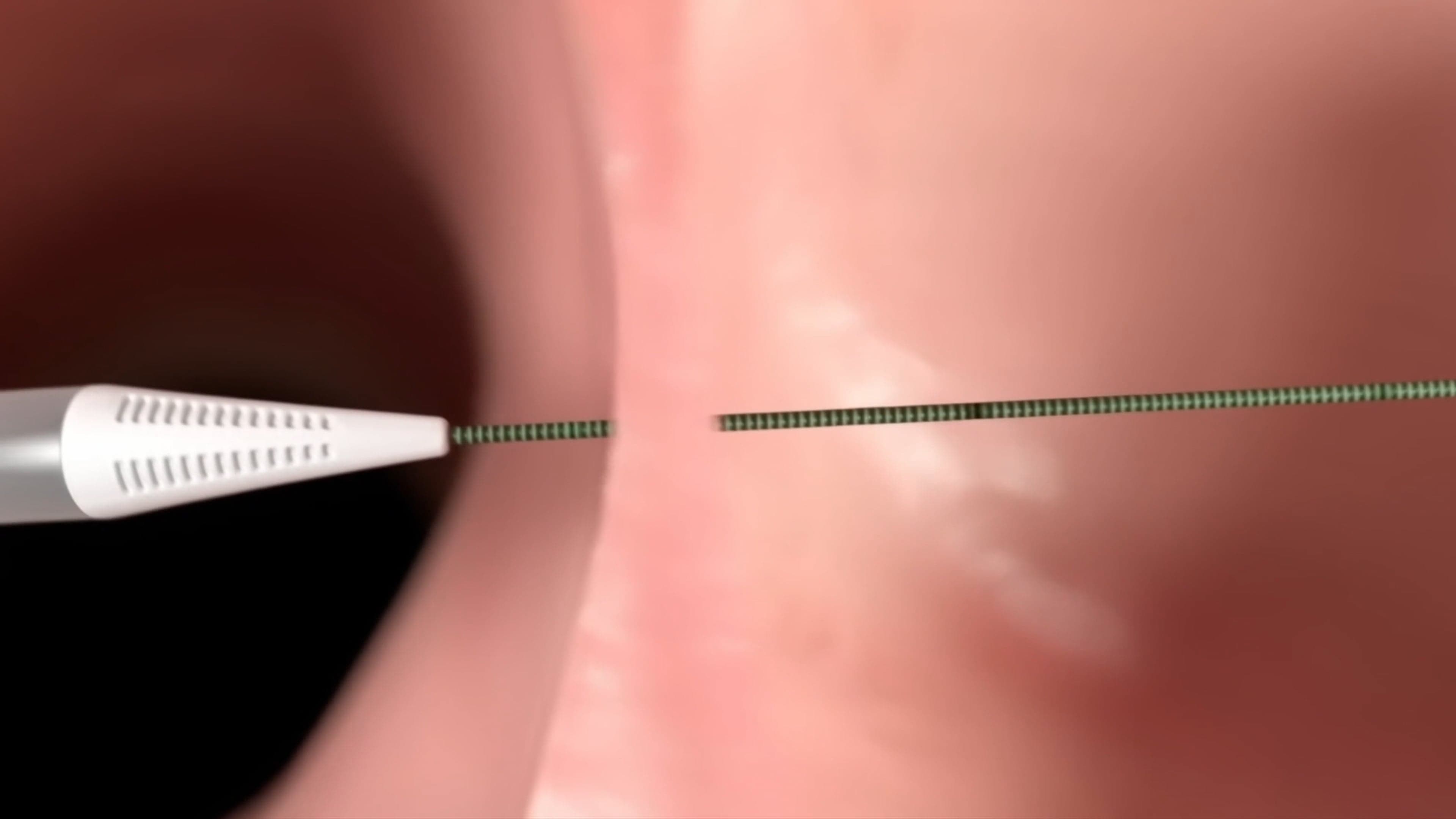 How is the Alleviant shunt created?